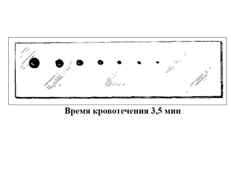 Время кровотечения 3,5 мин